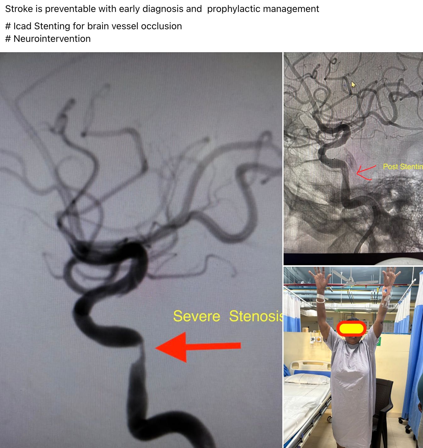 ICAD Stenting in Bhubaneswar – Preventing Stroke from Brain Vessel Occlusion